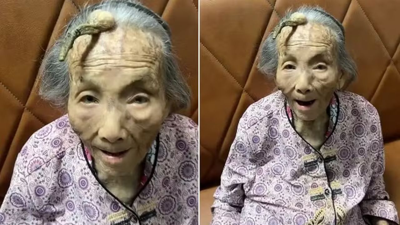 Idosa chinesa de 107 anos viraliza por ‘chifre’ crescendo na testa