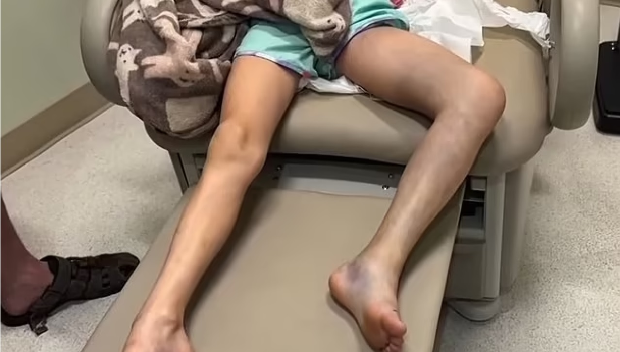 Veneno de cobra fica alojado no corpo de menina por mais de 30 horas