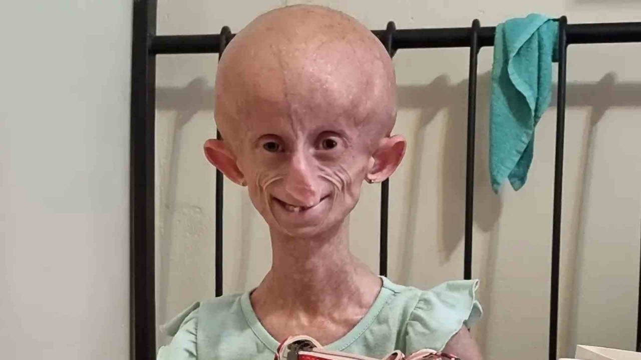 Morre Beandri Booysen, influencer que tinha síndrome rara