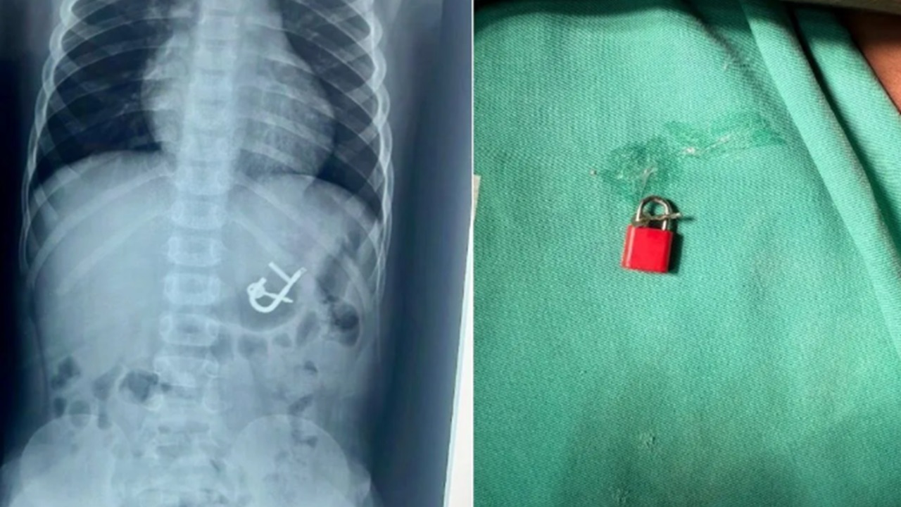 Criança de 4 anos engole cadeado e passa por cirurgia para remoção