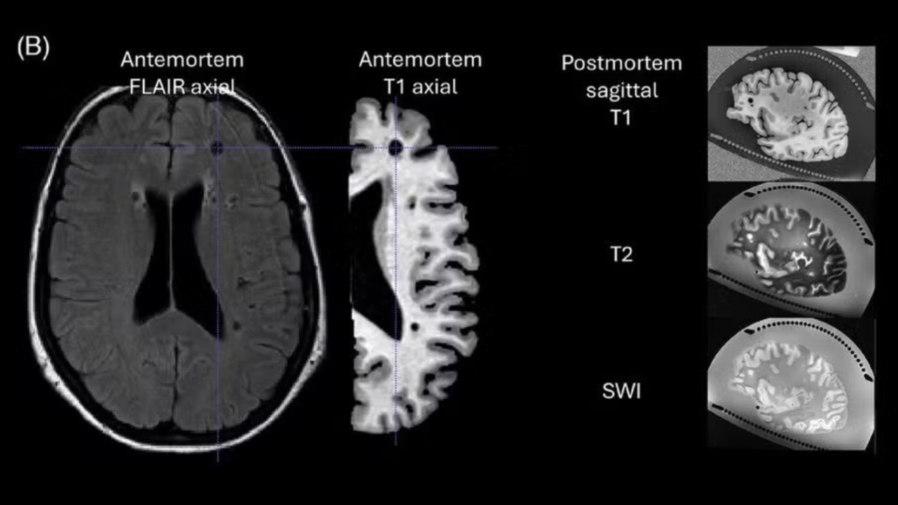 Caso de mulher com Alzheimer sem perda cognitiva surpreende cientistas