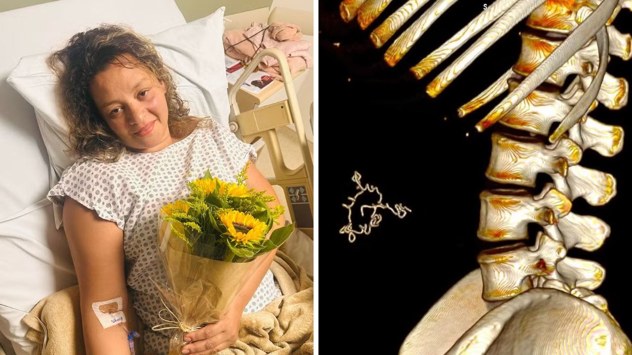 Cinco anos após cesárea, mulher descobre compressa esquecida no abdômen