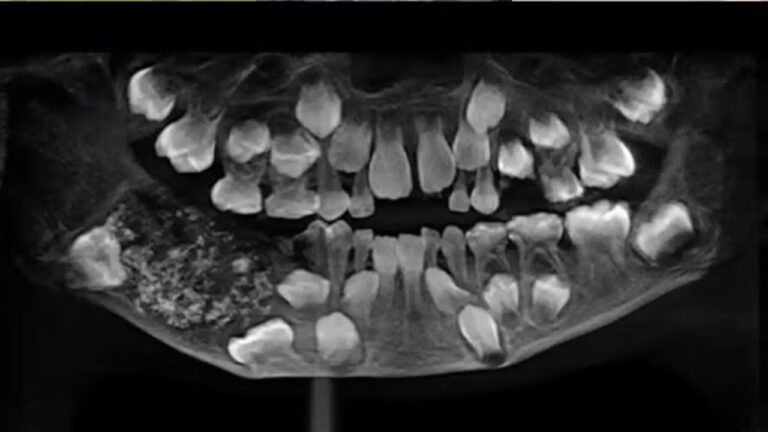 Cirurgiões removem 526 dentes de boca de menino na Índia