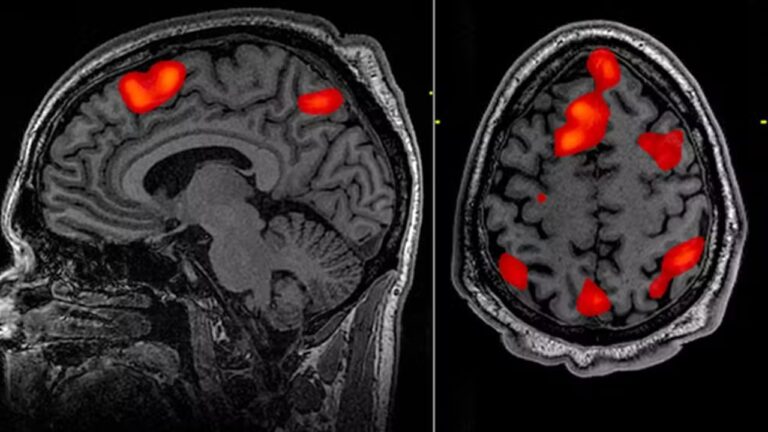 Terapia genética freia avanço da doença de Huntington em 75%