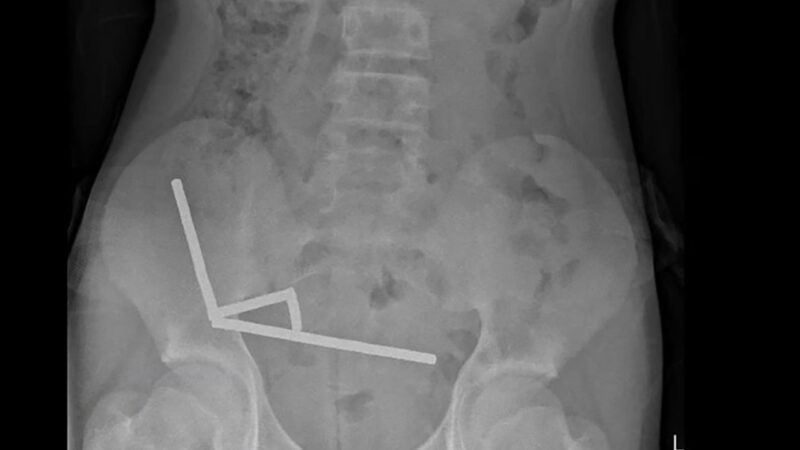 Médicos removem quase 100 ímãs de intestino de adolescente