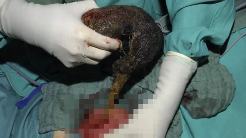 Médicos removem enorme bola de cabelo de estômago de menina na Índia