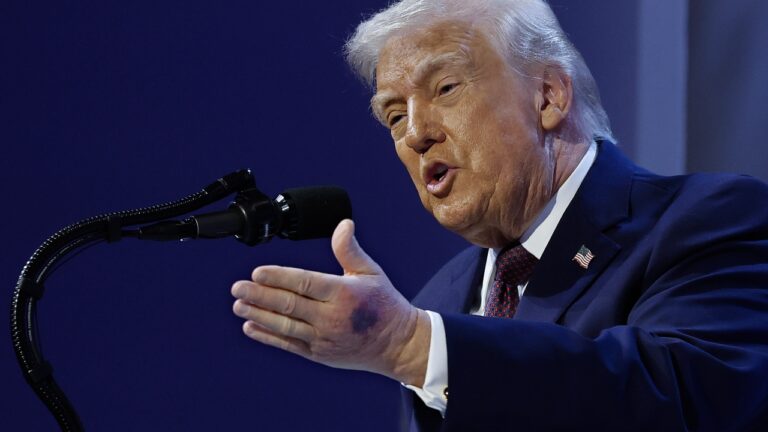 Hematoma na mão de Donald Trump chama atenção pública durante aparição