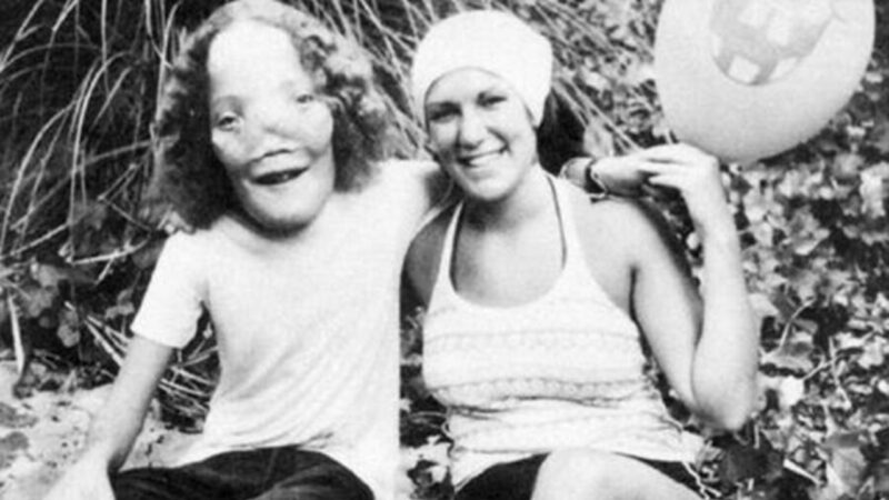 Rocky Dennis: conheça a vida do menino cuja deformidade rara inspirou filme