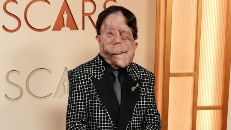 Conheça a doença rara e degenerativa do ator Adam Pearson