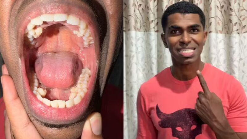 Com 42 dentes na boca, malaio detém recorde e entra no Guinness
