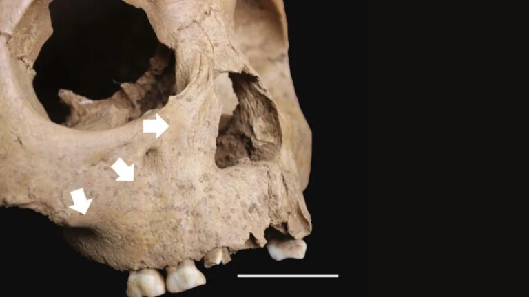 Estudo revela doença similar à sífilis em crianças há 4 mil anos no Vietnã