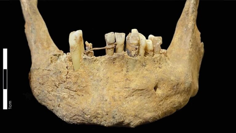 Ponte dentária de ouro é descoberta em túmulo medieval na Escócia