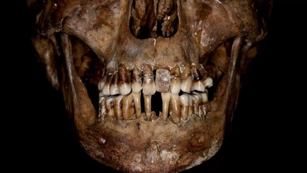 Mulher francesa do século 17 é encontrada com “aparelho dental” de ouro