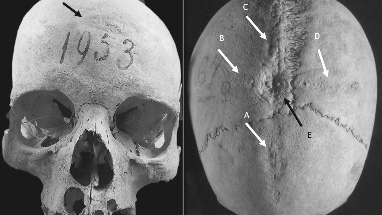 Mulher que viveu há 1.300 anos teria passado por várias cirurgias cranianas