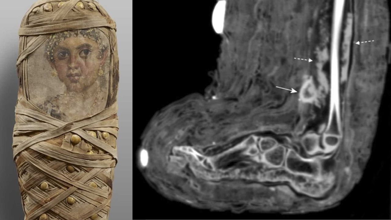 A curiosa descoberta da criança mumificada que mostrou como eram os curativos egípcios