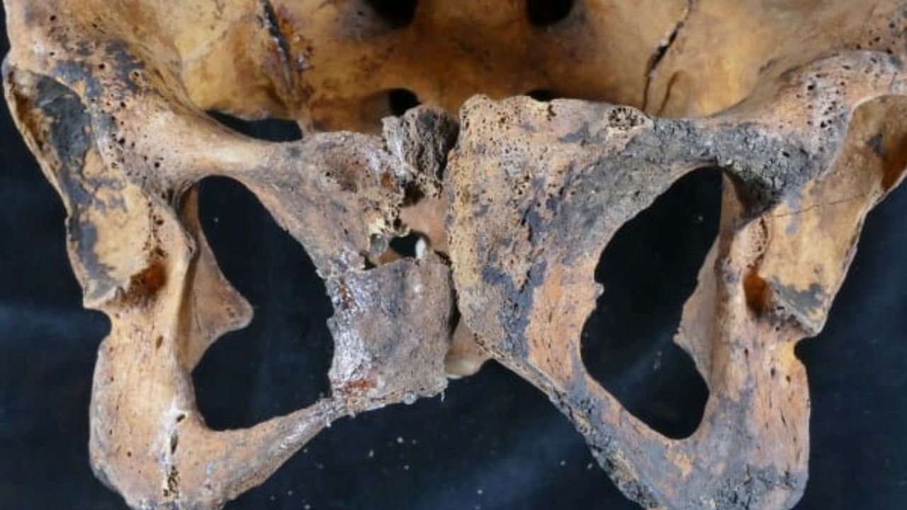 Esqueleto de 4 mil anos revela evidências de mais antigo tratamento ginecológico