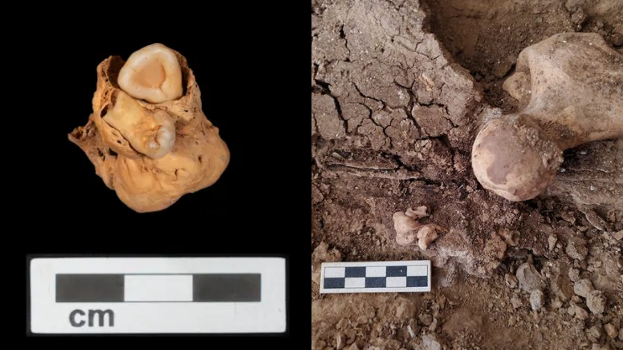 Raro tumor com dentes é encontrado em sepultura egípcia de 3 mil anos