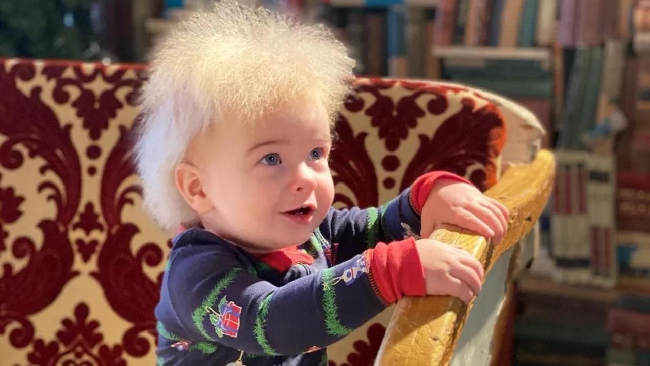 O que é a ‘síndrome do cabelo impenteável’, diagnosticada em garoto de 10 meses
