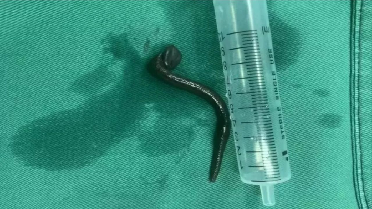 Criança dá entrada em hospital por falta de ar e descobre sanguessuga de 15 cm