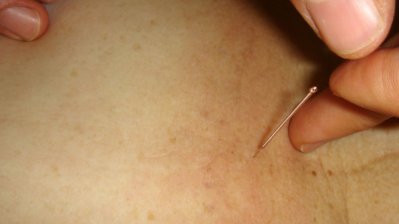 Mulher tem pulmão perfurado durante sessão de acupuntura e passa por cirurgia de emergência