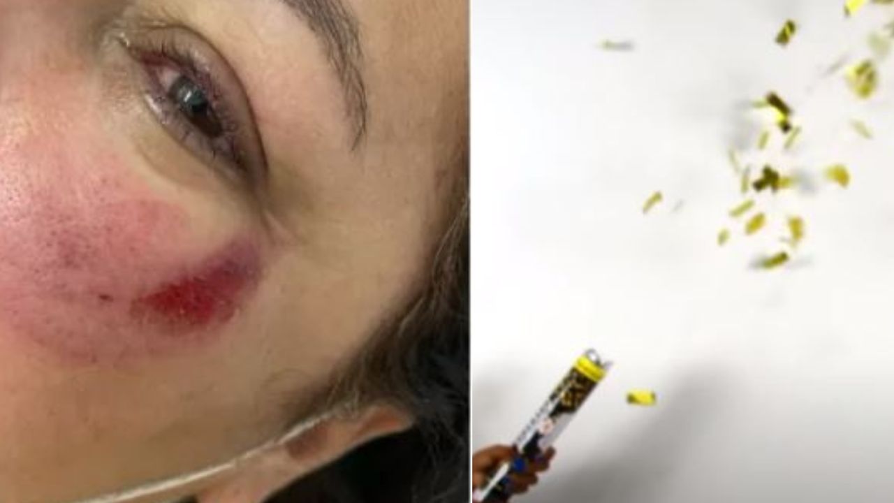 Professora fere o olho depois de ser atingida por um lança-confetes