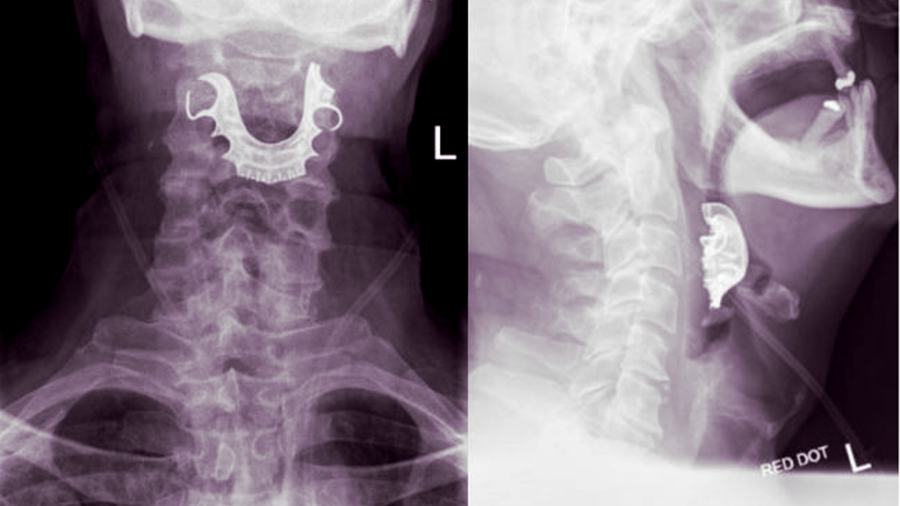 Homem engole dentadura e vive momentos de horror durante uma semana