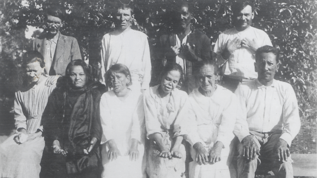Por que a histórica hanseníase, doença bíblica, ainda mata pessoas?