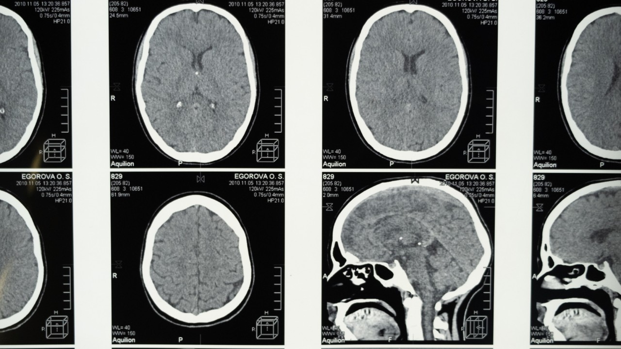 Cientistas podem ter encontrado resposta para “vida passando diante dos olhos” antes da morte
