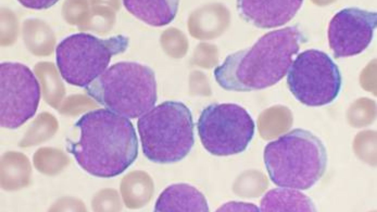 Pesquisa aponta tratamento novo e eficaz contra leucemia