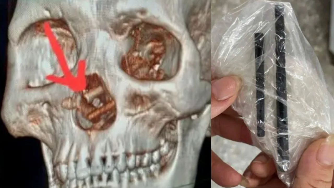 Homem descobre que dor de cabeça era causada por hashis presos no cérebro