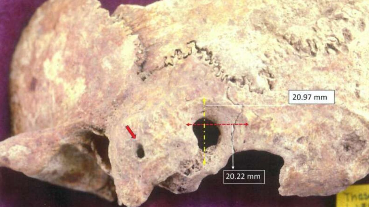 Esqueletos encontrados na Grécia revelam que povos antigos realizaram uma precoce cirurgia cerebral