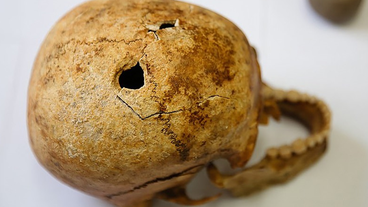 Há 4.000 anos, um guerreiro teve seu crânio perfurado para curar uma dor de cabeça, indicam arqueólogos