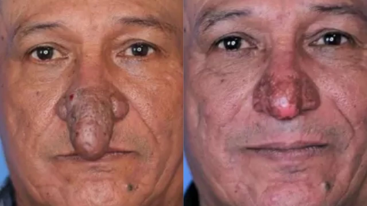 Homem com deformidade tem nariz reconstruído