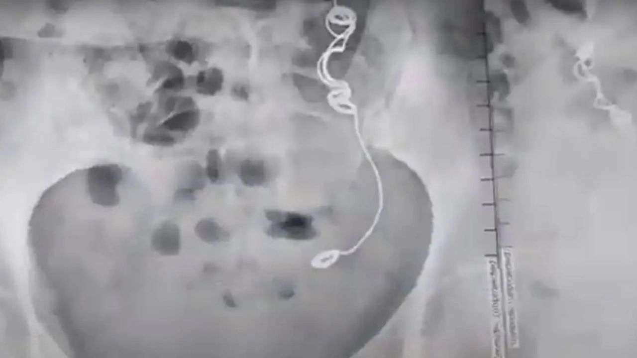 10 anos após cirurgia, mulher descobre agulha esquecida dentro de seu estômago