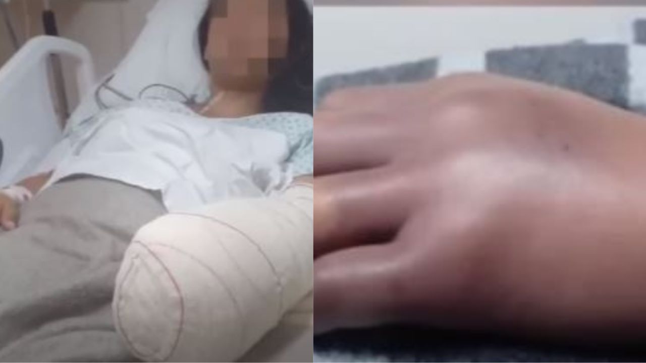 Hospital explica o motivo de amputação de mãos de mulher depois de parto
