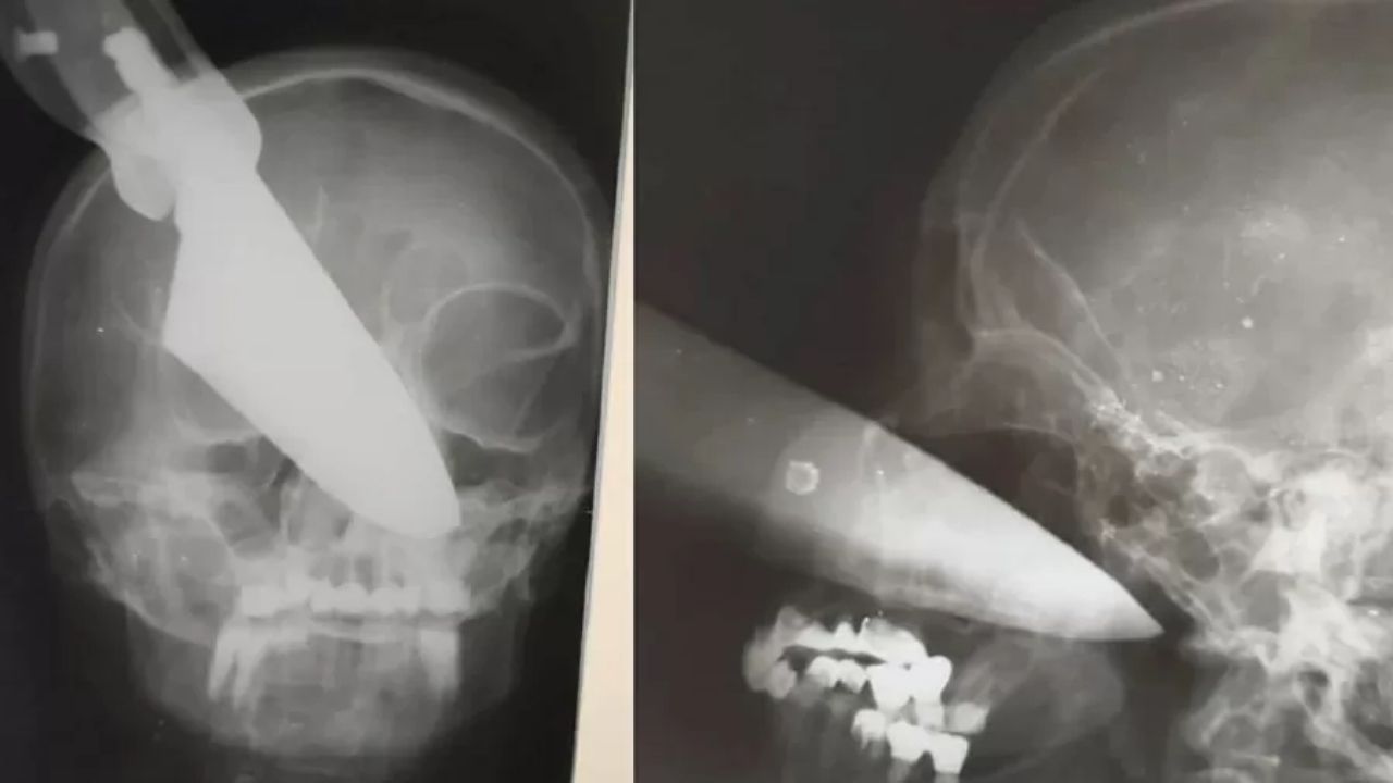 Russa fica com faca de 25 cm presa no rosto após sofrer tentativa de homicídio