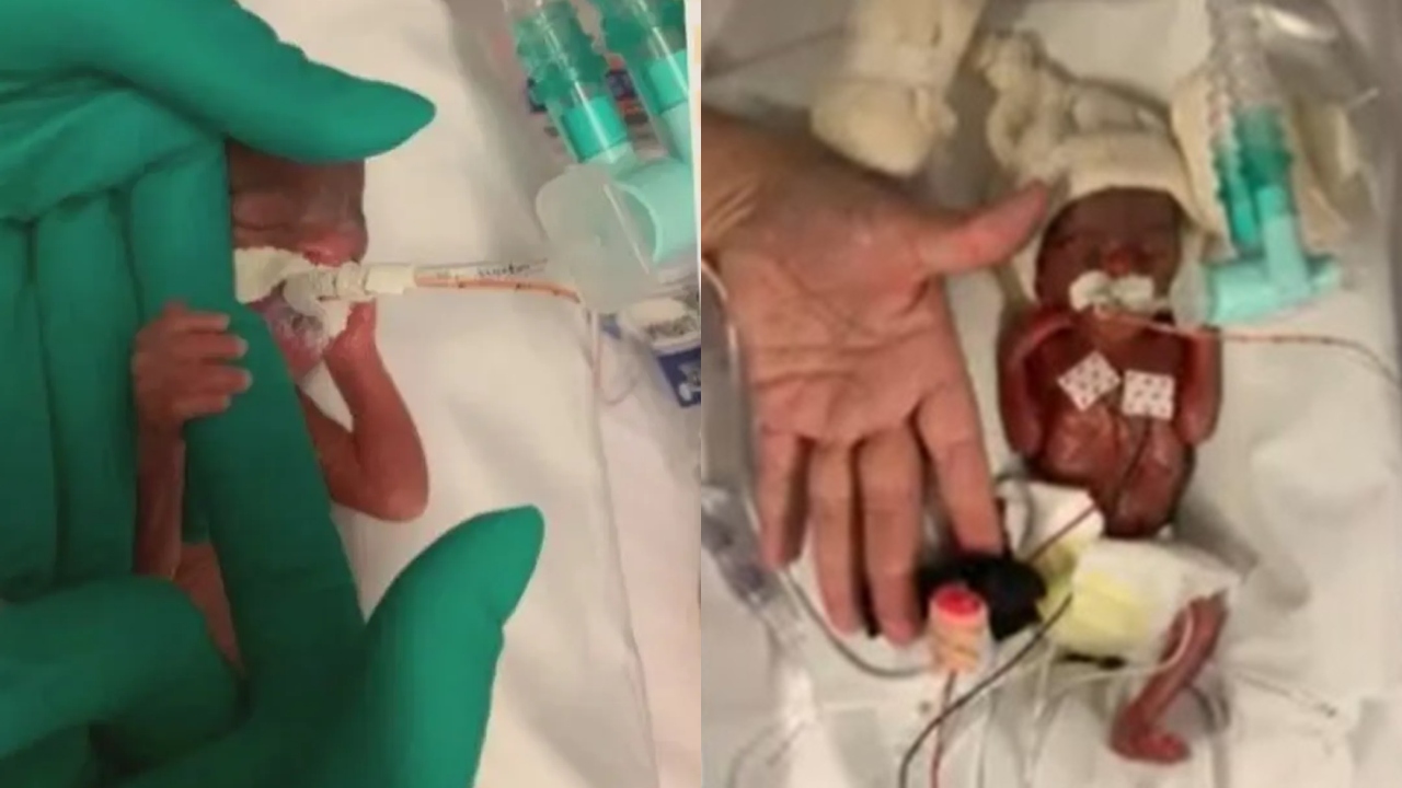 Em São Paulo, bebê nasce com 335 gramas e 25 cm