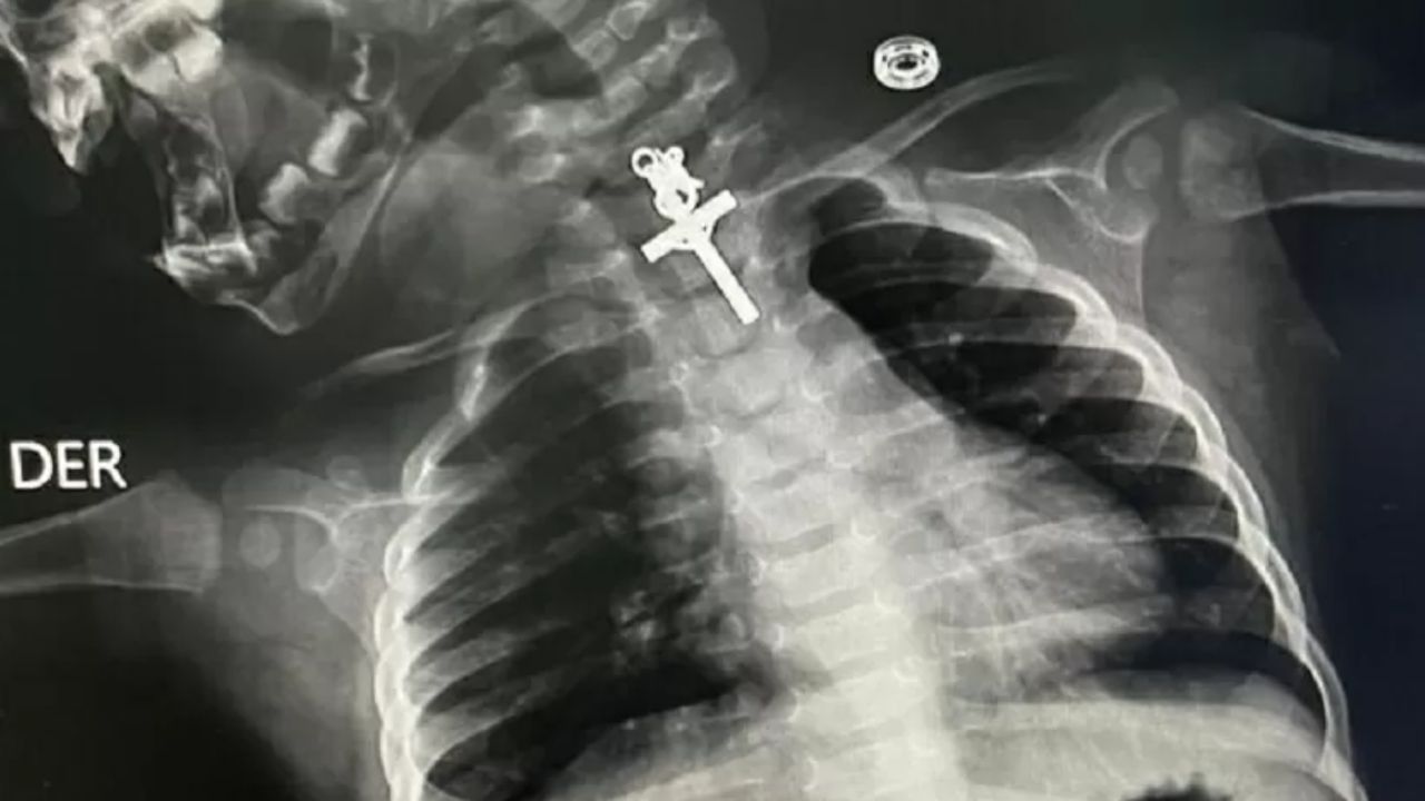 Peru: Bebê de 10 meses é operado para retirar crucifixo alojado no esôfago