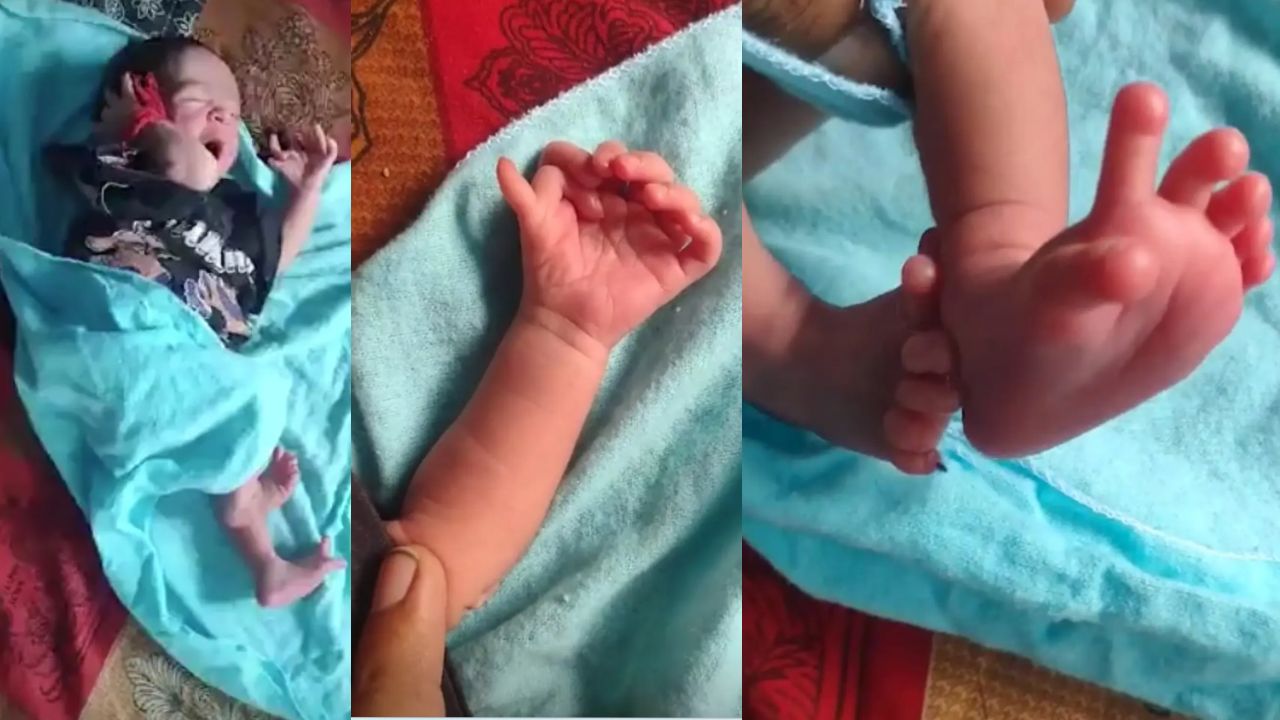 Índia: Bebê nascido com 26 dedos é visto como reencarnação de deusa hindu