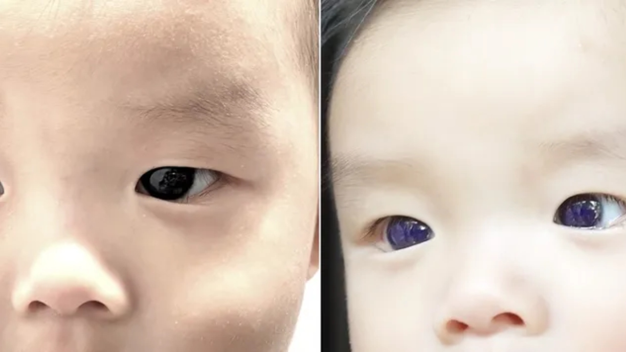 Bebê tem alteração na cor dos olhos após reação ao tratamento de Covid