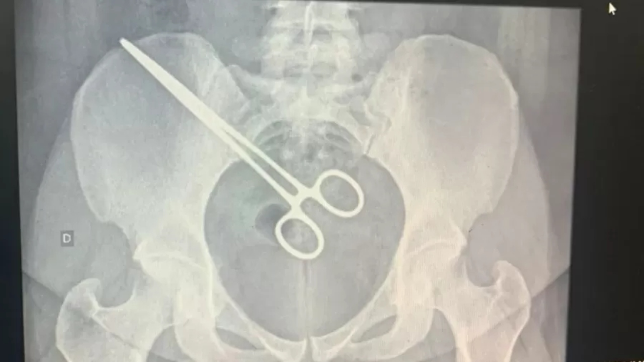 Mulher descobre objeto metálico em seu corpo ao visitar marido na prisão