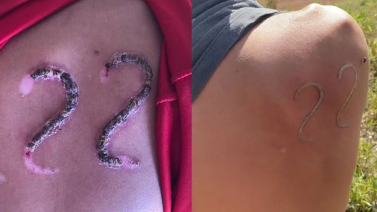 Jovem marca homenagem a Bolsonaro com ferro em brasa