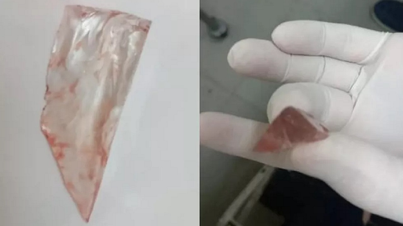 Jovem descobre vidro de 5cm em suas costas um mês após acidente
