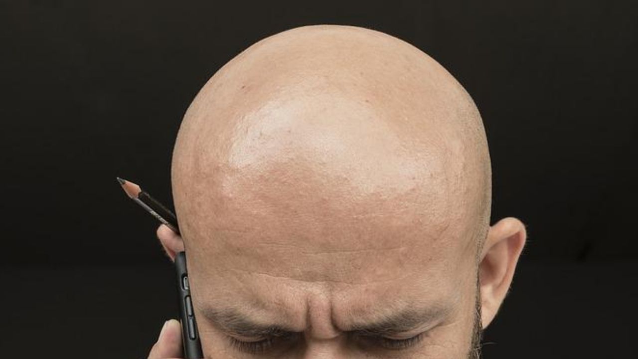 Tribunal inglês decide que chamar homem de ‘careca’ configura assédio sexual