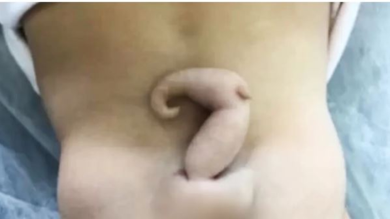 Bebê que nasceu com cauda de 6 centímetros em Jundiaí é alvo de estudo