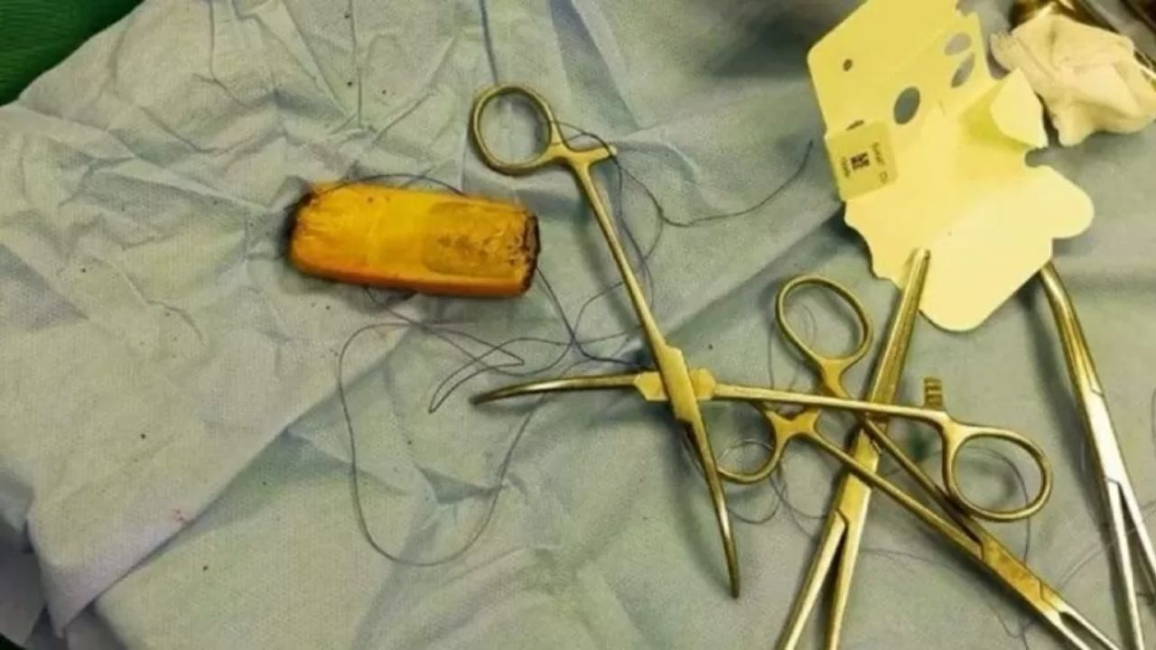Egípcio diz que esperava eliminar celular engolido de ‘forma natural’, mas precisa passar por cirurgia