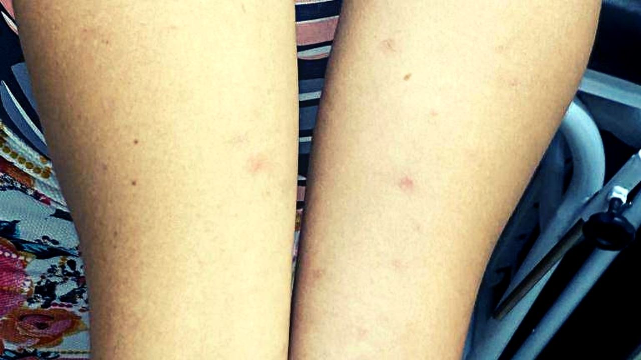 Dermatologistas descobrem o motivo de surto de coceira em Recife