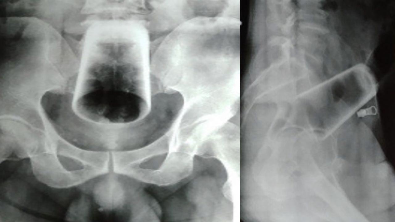 Após inserir copo de vidro no ânus, homem precisa ser operado no Nepal