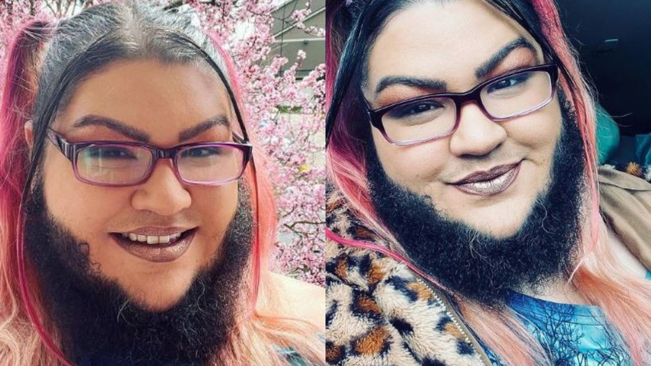 Mulher com hirsutismo assume pelos faciais