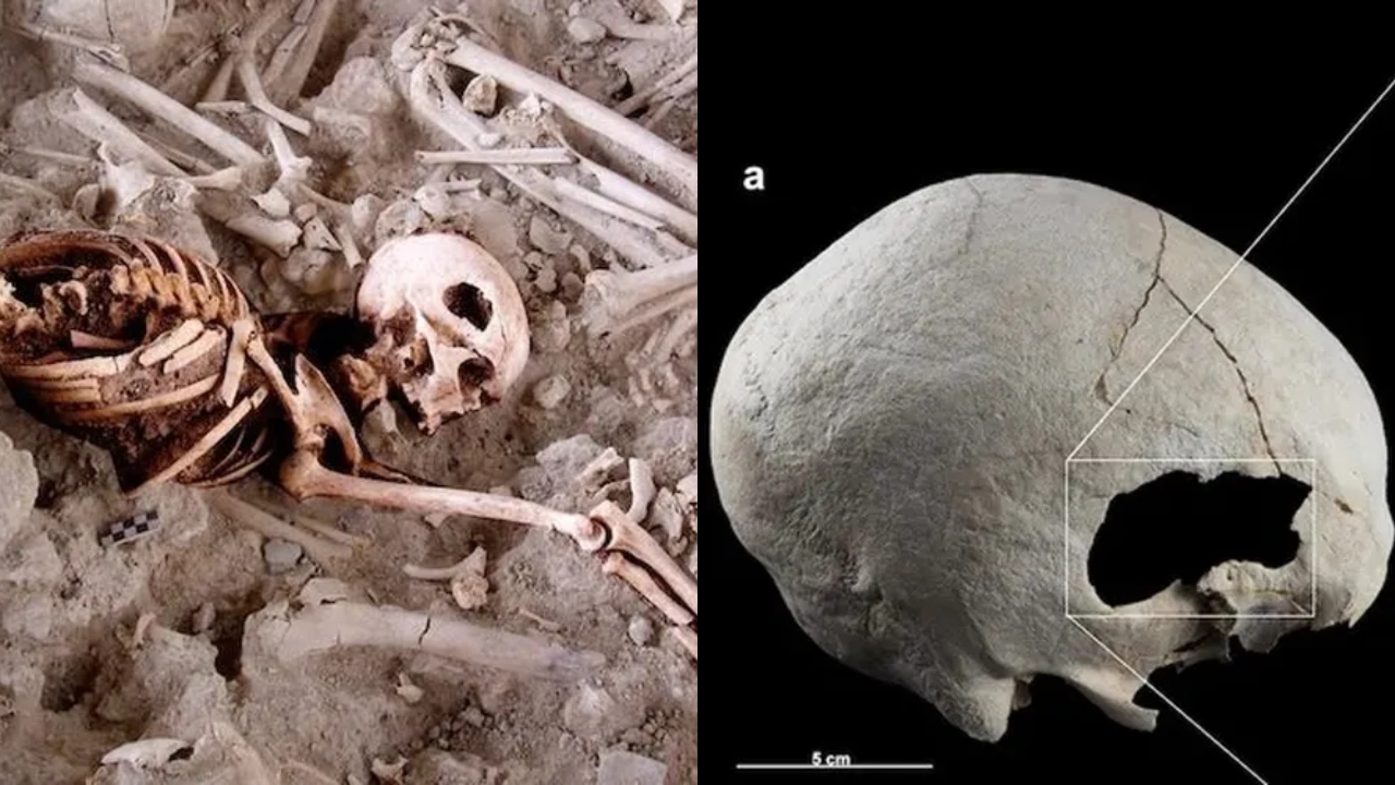 Estudo revela que há 4,5 mil anos mulher teria sobrevivido a duas cirurgias no crânio